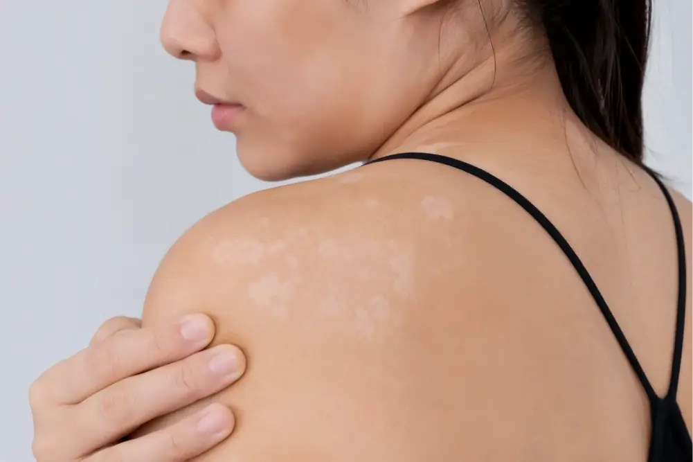 White Spots on Skin: Causes, Symptoms, Treatment and Prevention